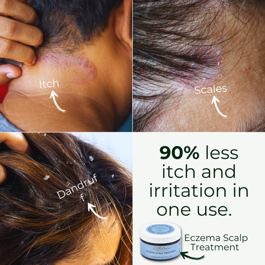 Eczema Scalp Treatment w/Tea Tree & Neem