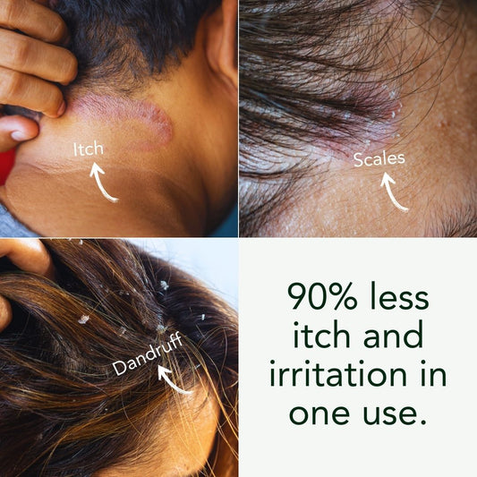 Eczema Scalp Treatment w/Tea Tree & Neem